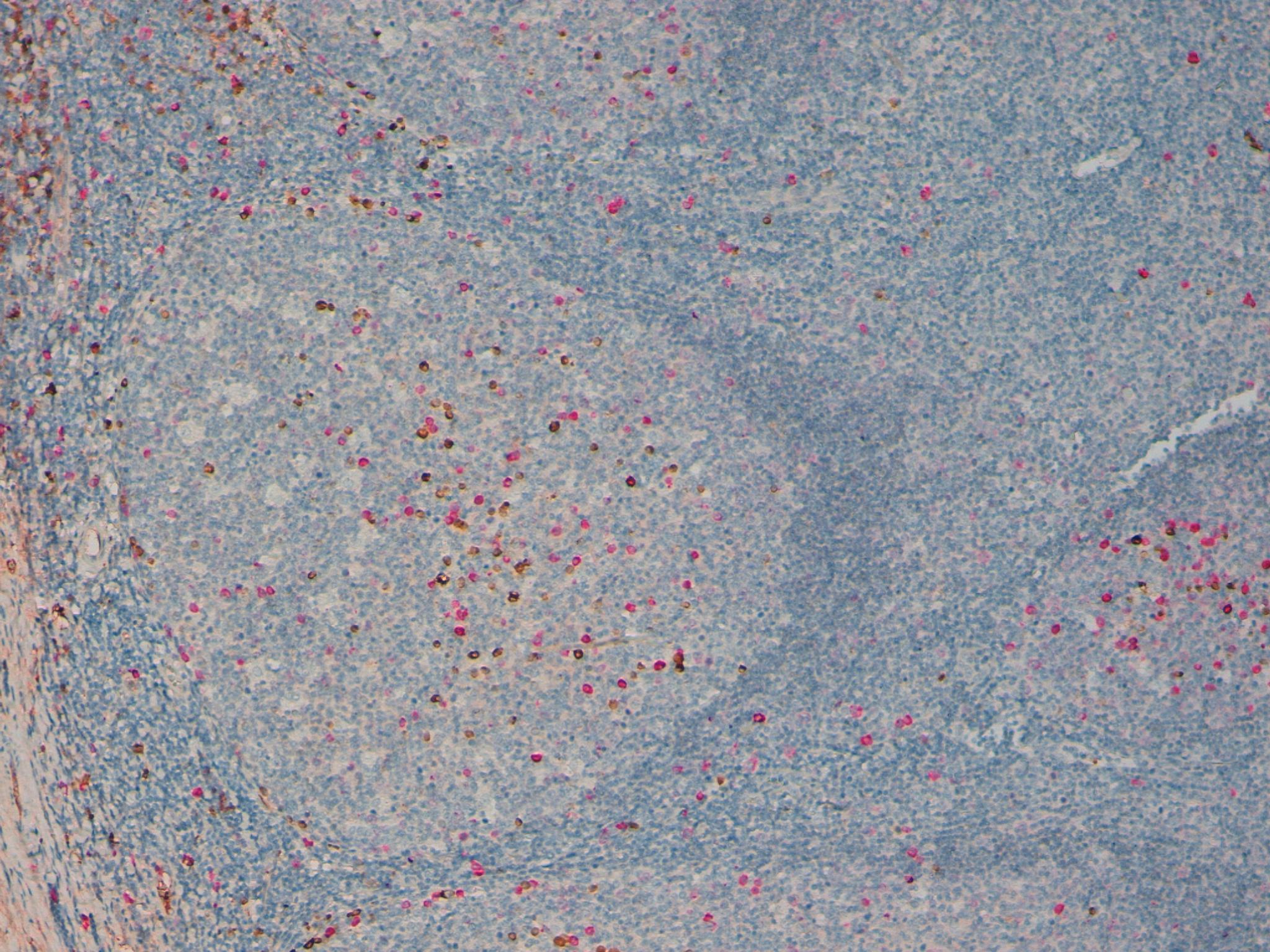 Kappa Lambda Double Staining 10x