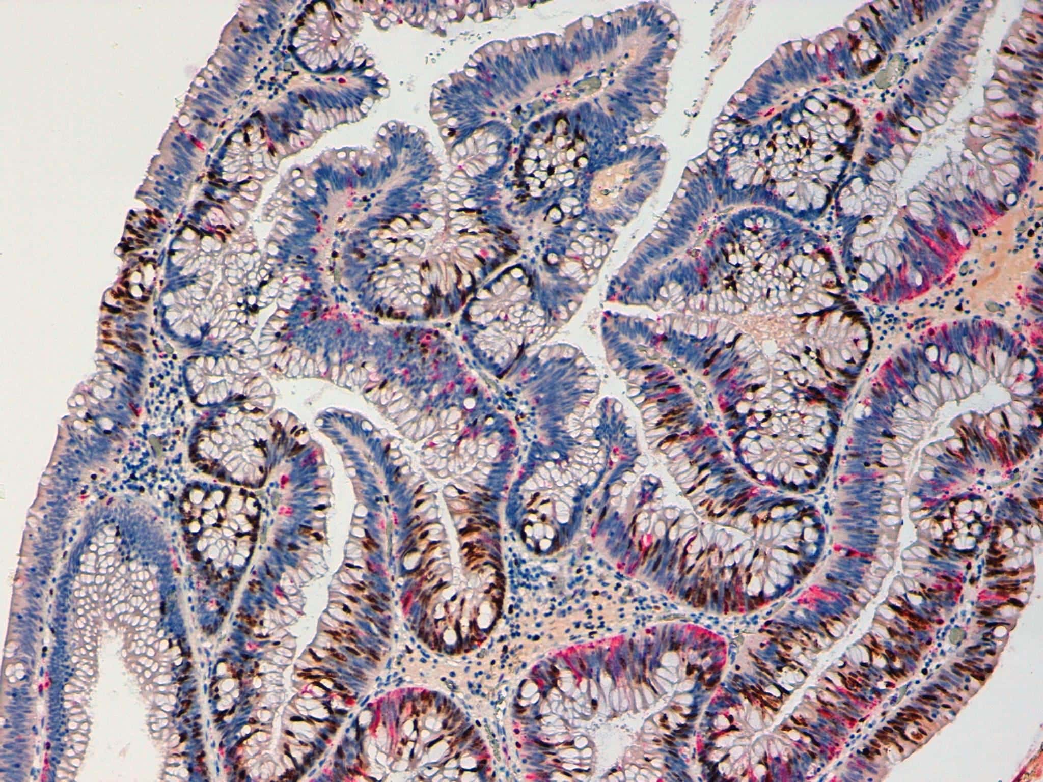 Ki67 and Caspase 3 - Double Staining 10x