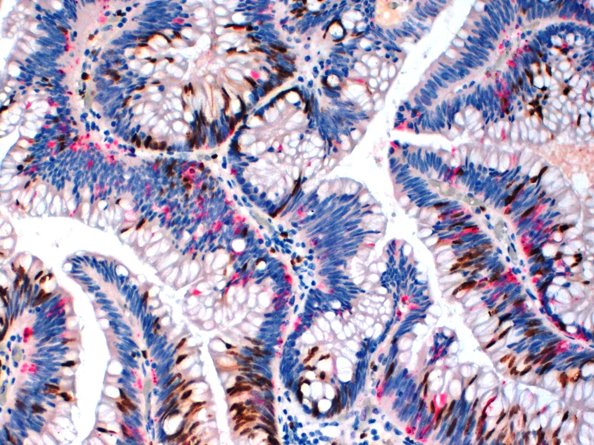 Ki67 and Caspase 3 - Double Staining 20x